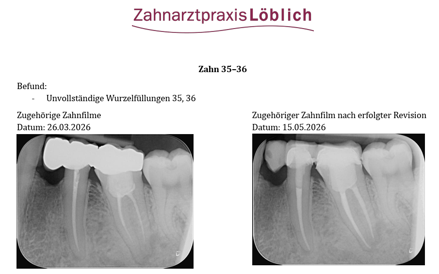 Zähne 35 und 36 – Vergleich vor und nach Revision der Wurzelkanalbehandlungen